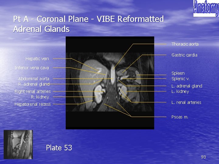 Pt A - Coronal Plane - VIBE Reformatted Adrenal Glands Thoracic aorta Hepatic vein