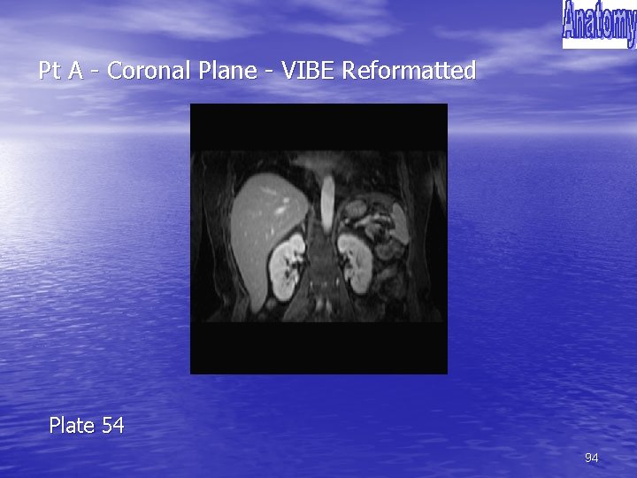 Pt A - Coronal Plane - VIBE Reformatted Plate 54 94 