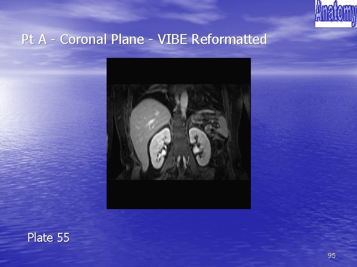 Pt A - Coronal Plane - VIBE Reformatted Plate 55 95 