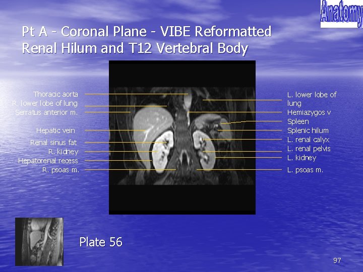 Pt A - Coronal Plane - VIBE Reformatted Renal Hilum and T 12 Vertebral