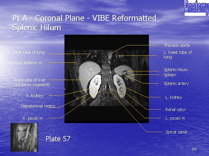 Pt A - Coronal Plane - VIBE Reformatted Splenic Hilum Thoracic aorta R. lower