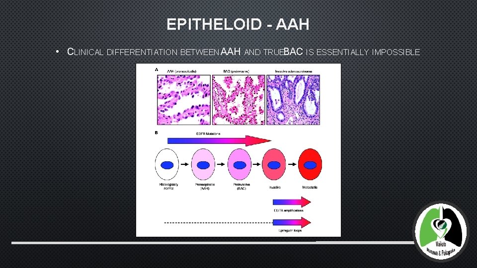 EPITHELOID - AAH • CLINICAL DIFFERENTIATION BETWEEN AAH AND TRUEBAC IS ESSENTIALLY IMPOSSIBLE 