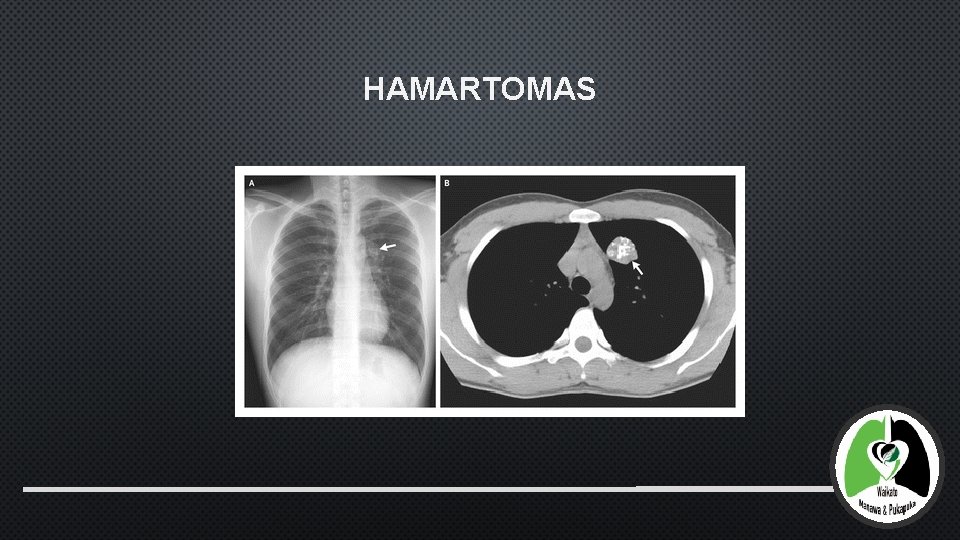 HAMARTOMAS 