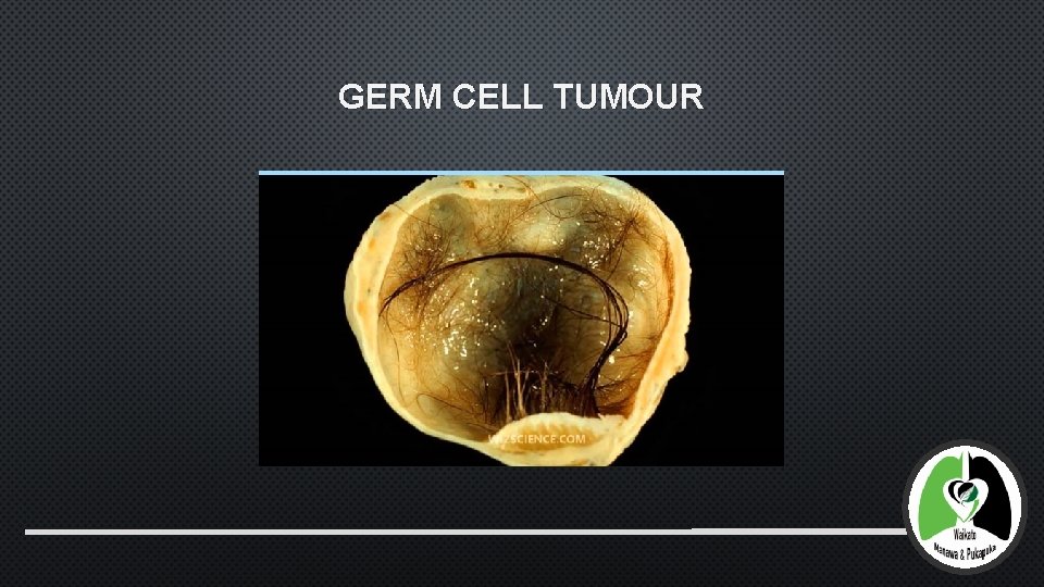 GERM CELL TUMOUR 