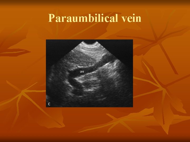 Paraumbilical vein 