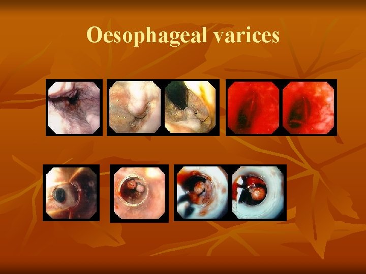 Oesophageal varices 