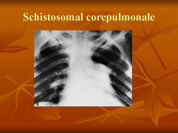 Schistosomal corepulmonale 