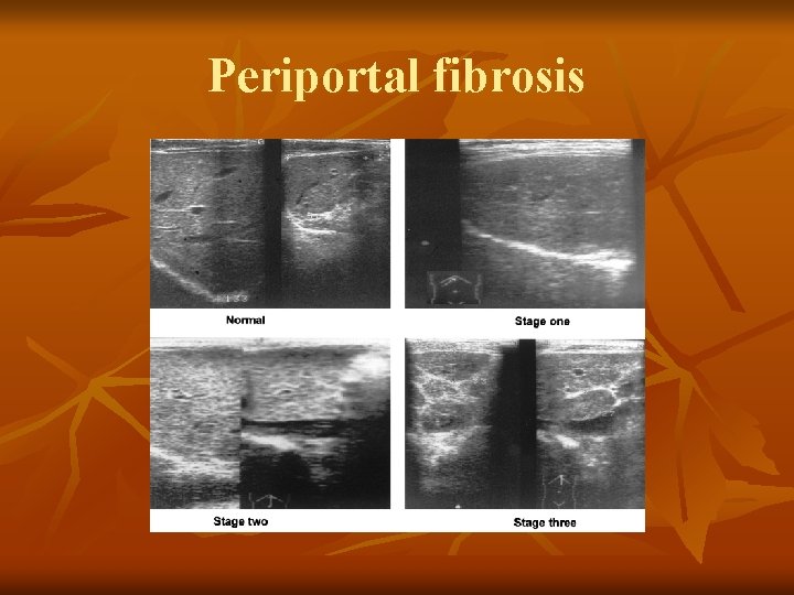 Periportal fibrosis 