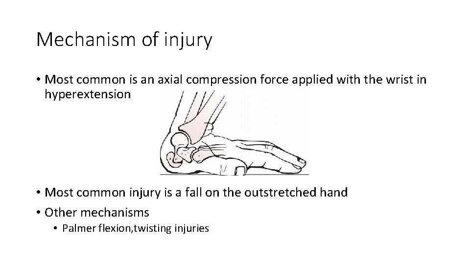 Mechanism of injury • Most common is an axial compression force applied with the