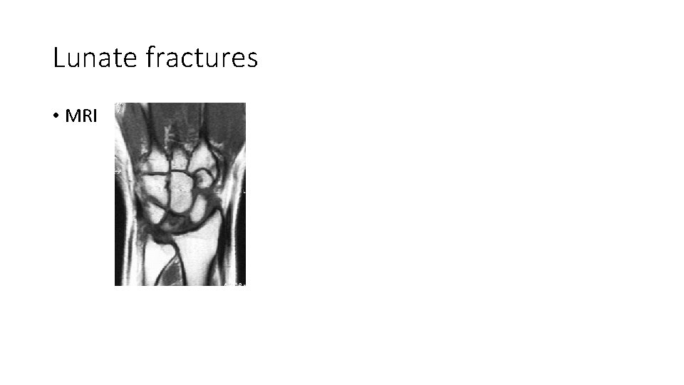 Lunate fractures • MRI 