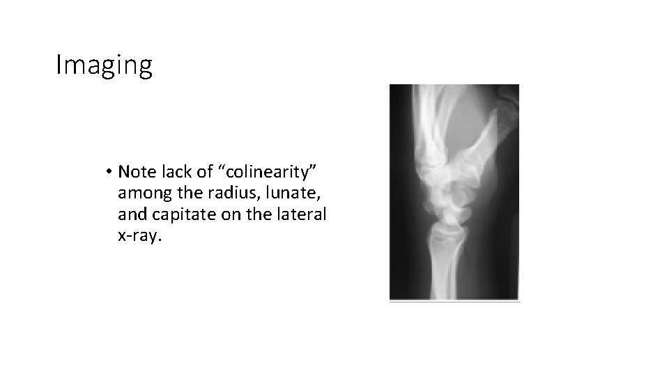 Imaging • Note lack of “colinearity” among the radius, lunate, and capitate on the