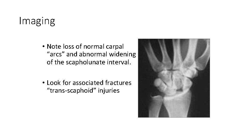 Imaging • Note loss of normal carpal “arcs” and abnormal widening of the scapholunate