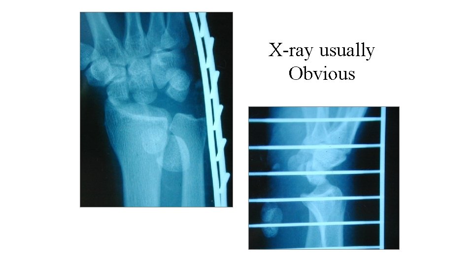 X-ray usually Obvious 