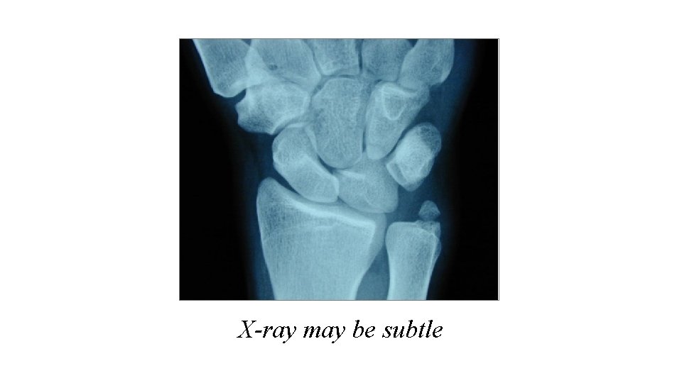 X-ray may be subtle 