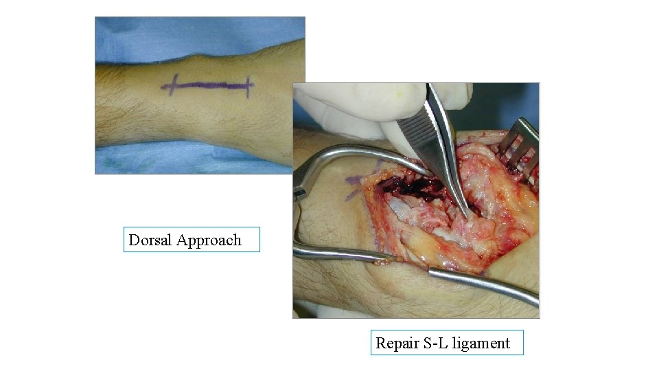 Dorsal Approach Repair S-L ligament 
