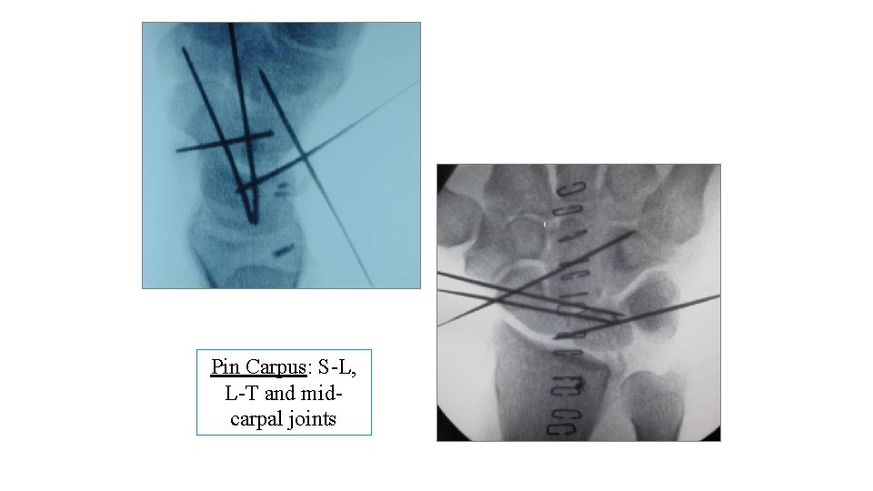 Pin Carpus: S-L, L-T and midcarpal joints 