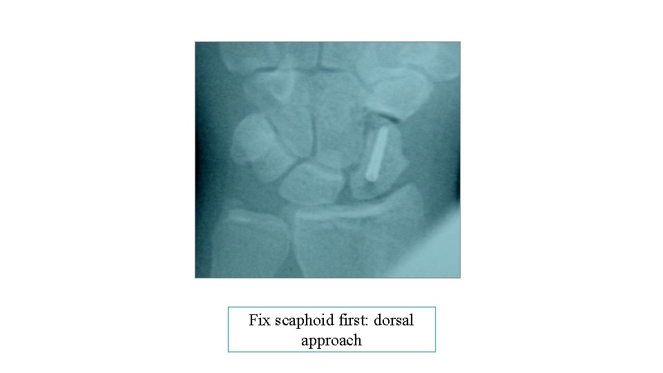 Fix scaphoid first: dorsal approach 