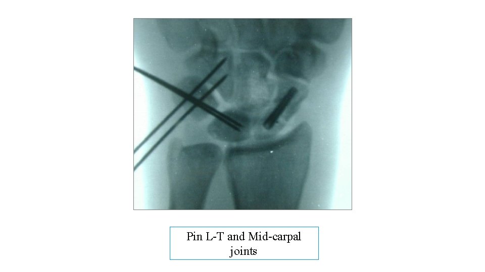 Pin L-T and Mid-carpal joints 