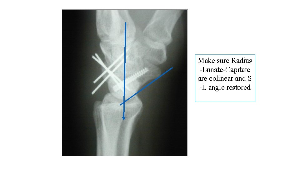 Make sure Radius -Lunate-Capitate are colinear and S -L angle restored 