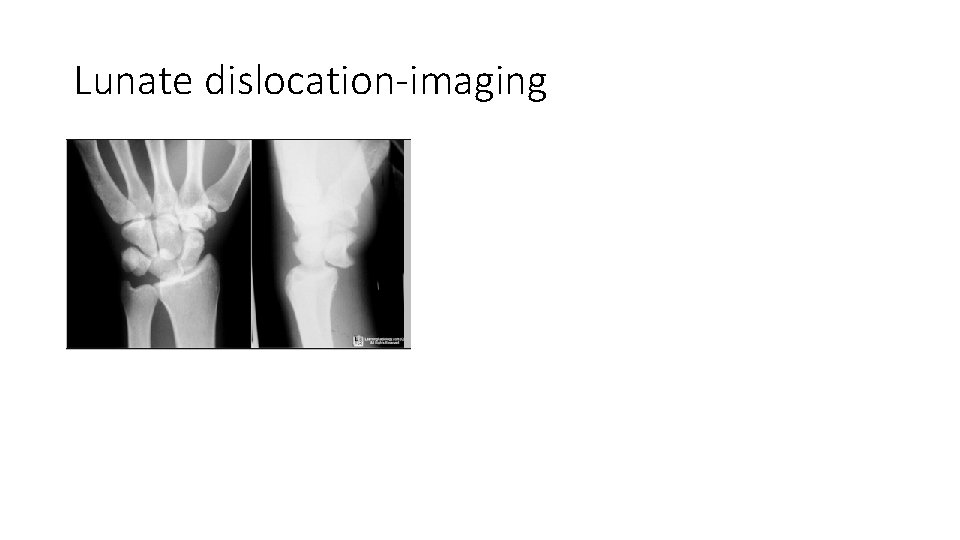 Lunate dislocation-imaging 