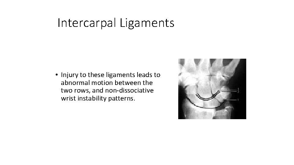 Intercarpal Ligaments • Injury to these ligaments leads to abnormal motion between the two