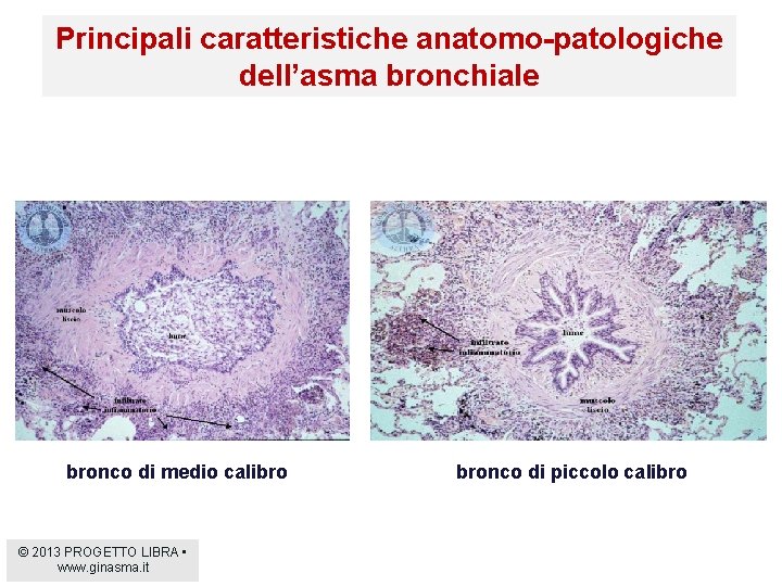 Principali caratteristiche anatomo-patologiche dell’asma bronchiale bronco di medio calibro © 2013 PROGETTO LIBRA •