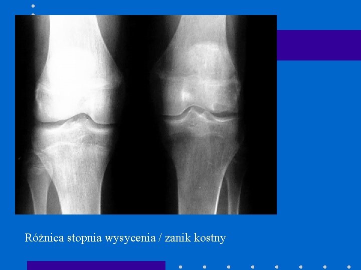 Różnica stopnia wysycenia / zanik kostny 