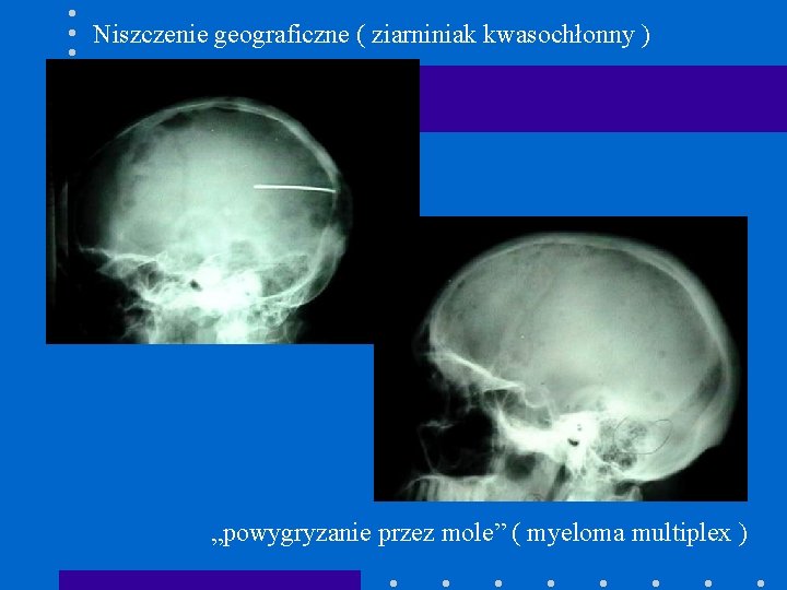 Niszczenie geograficzne ( ziarniniak kwasochłonny ) „powygryzanie przez mole” ( myeloma multiplex ) 