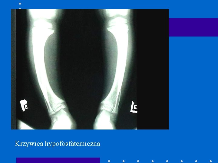 Krzywica hypofosfatemiczna 