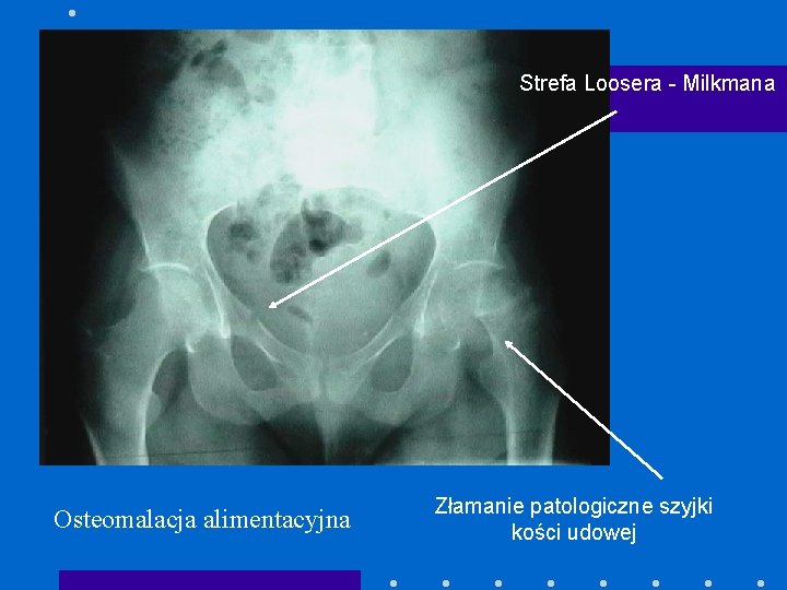 Strefa Loosera - Milkmana Osteomalacja alimentacyjna Złamanie patologiczne szyjki kości udowej 