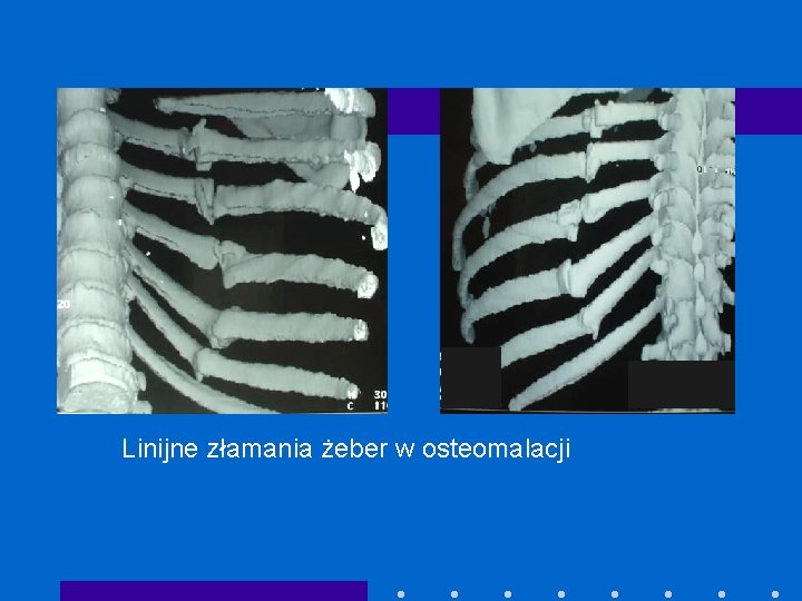 Linijne złamania żeber w osteomalacji 