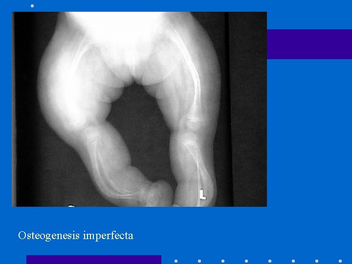 Osteogenesis imperfecta 