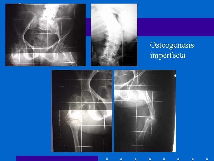 Osteogenesis imperfecta 