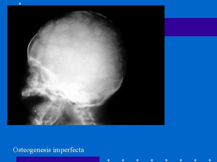 Osteogenesis imperfecta 