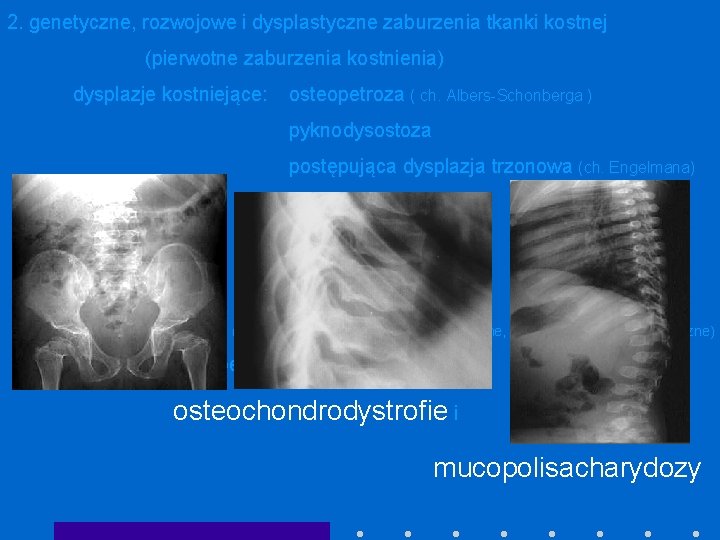 2. genetyczne, rozwojowe i dysplastyczne zaburzenia tkanki kostnej (pierwotne zaburzenia kostnienia) dysplazje kostniejące: osteopetroza