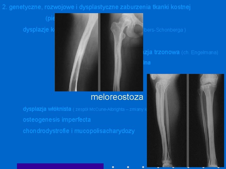 2. genetyczne, rozwojowe i dysplastyczne zaburzenia tkanki kostnej (pierwotne zaburzenia kostnienia) dysplazje kostniejące: osteopetroza