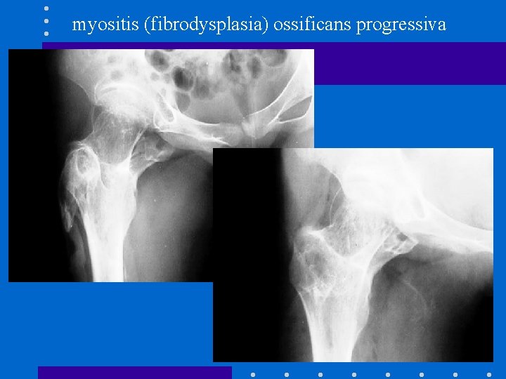 myositis (fibrodysplasia) ossificans progressiva 