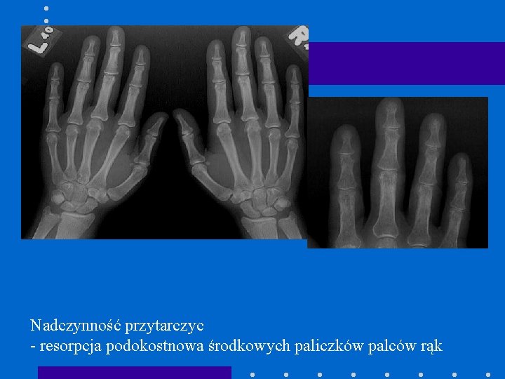 Nadczynność przytarczyc - resorpcja podokostnowa środkowych paliczków palców rąk 