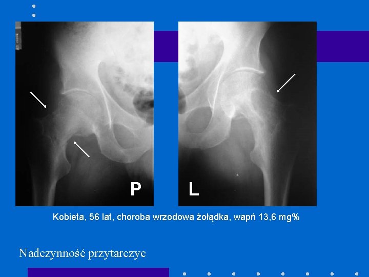 P L Kobieta, 56 lat, choroba wrzodowa żołądka, wapń 13, 6 mg% Nadczynność przytarczyc