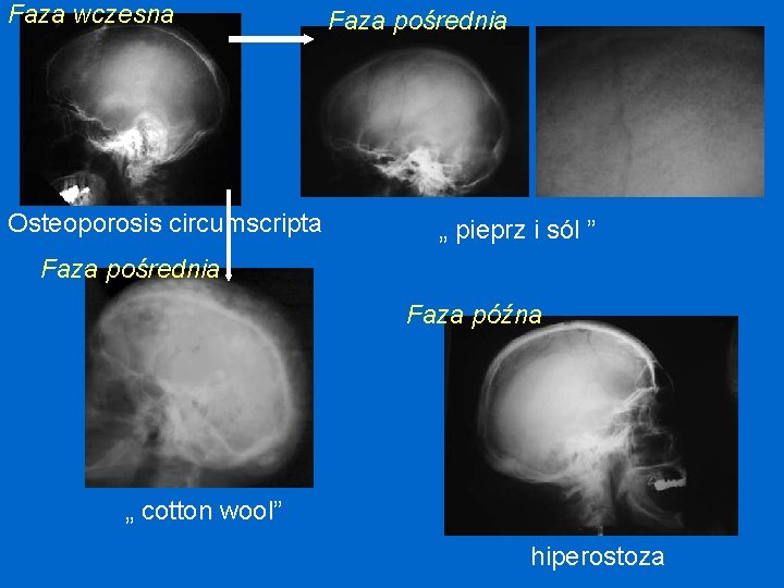 Faza wczesna Osteoporosis circumscripta Faza pośrednia „ pieprz i sól ” Faza pośrednia Faza