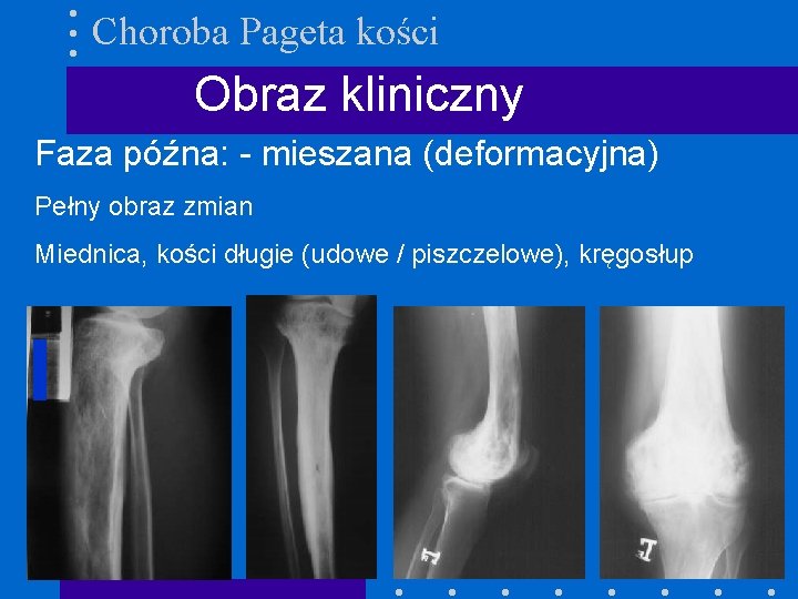 Choroba Pageta kości Obraz kliniczny Faza późna: - mieszana (deformacyjna) Pełny obraz zmian Miednica,