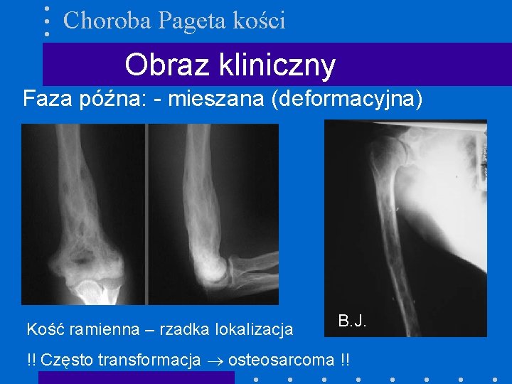 Choroba Pageta kości Obraz kliniczny Faza późna: - mieszana (deformacyjna) Kość ramienna – rzadka