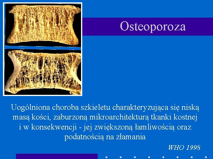 Osteoporoza Uogólniona choroba szkieletu charakteryzująca się niską masą kości, zaburzoną mikroarchitekturą tkanki kostnej i