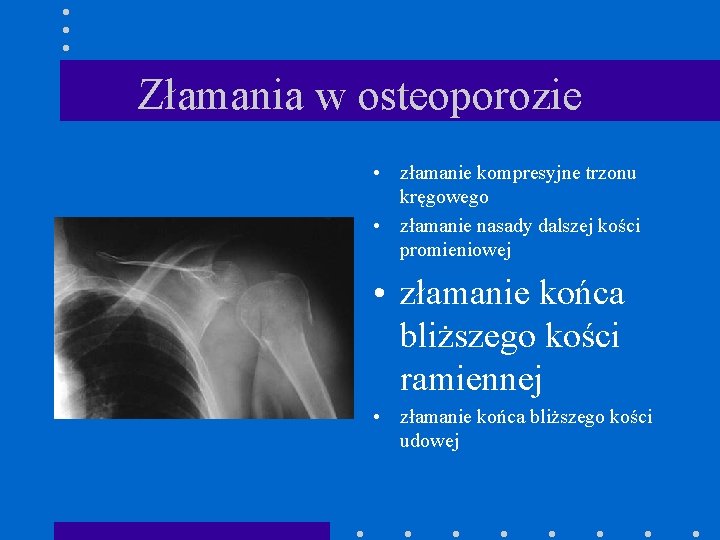 Złamania w osteoporozie • złamanie kompresyjne trzonu kręgowego • złamanie nasady dalszej kości promieniowej