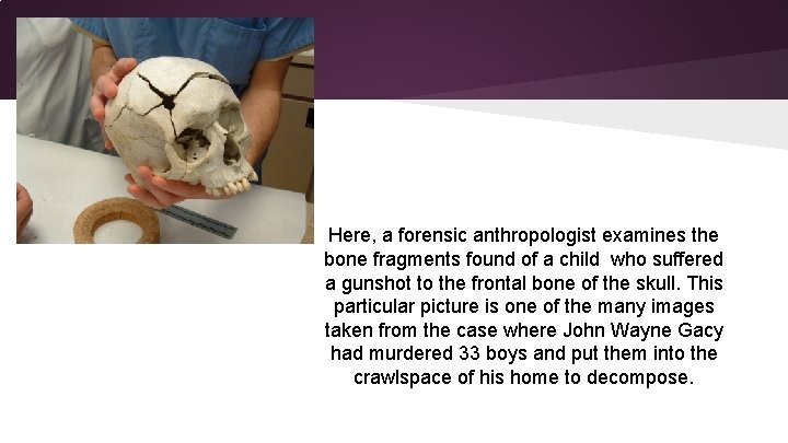 Here, a forensic anthropologist examines the bone fragments found of a child who suffered