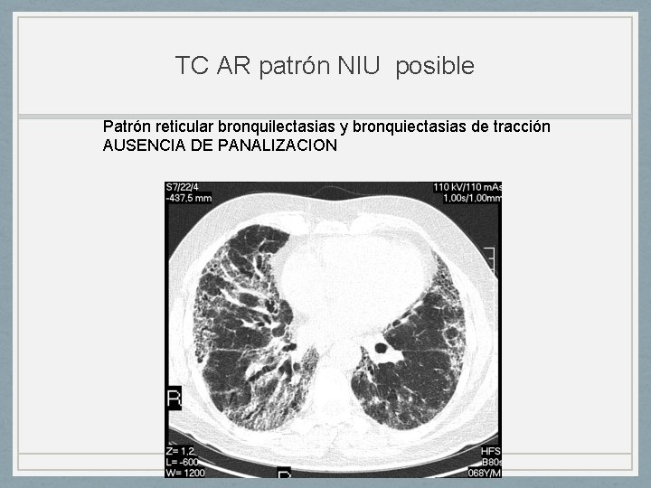 TC AR patrón NIU posible Patrón reticular bronquilectasias y bronquiectasias de tracción AUSENCIA DE