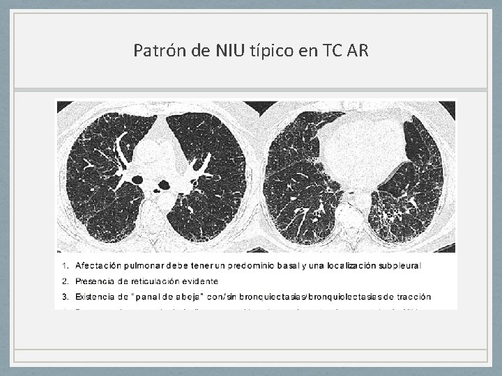 Patrón de NIU típico en TC AR 