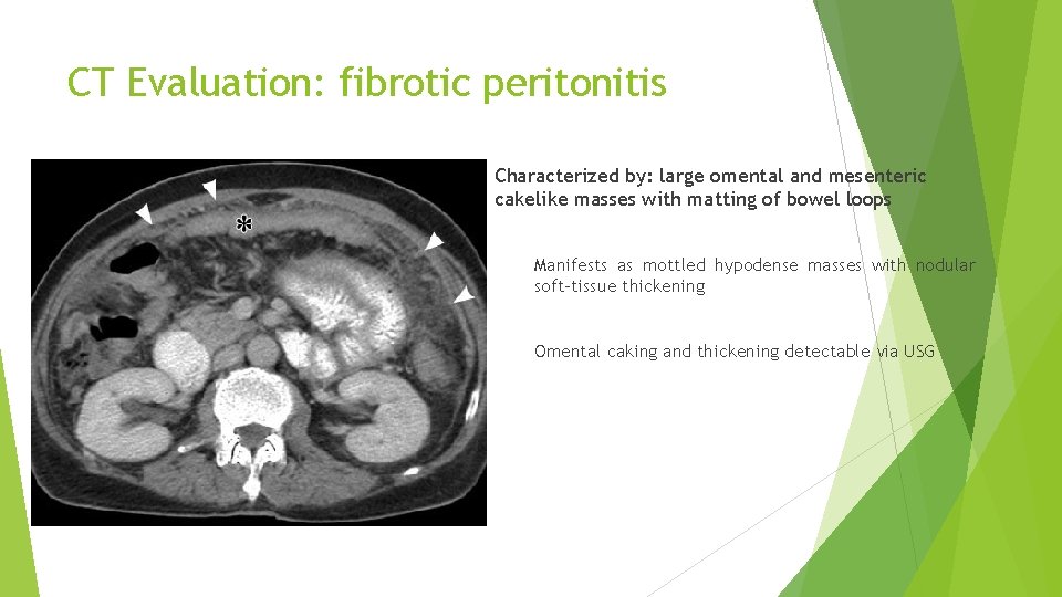 CT Evaluation: fibrotic peritonitis Characterized by: large omental and mesenteric cakelike masses with matting