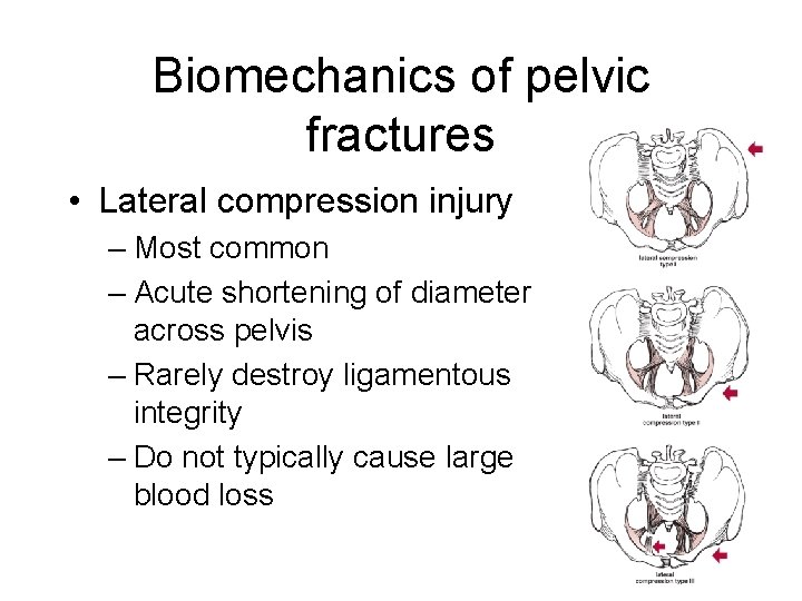 Biomechanics of pelvic fractures • Lateral compression injury – Most common – Acute shortening