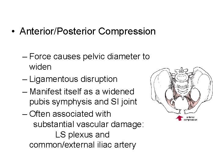  • Anterior/Posterior Compression – Force causes pelvic diameter to widen – Ligamentous disruption
